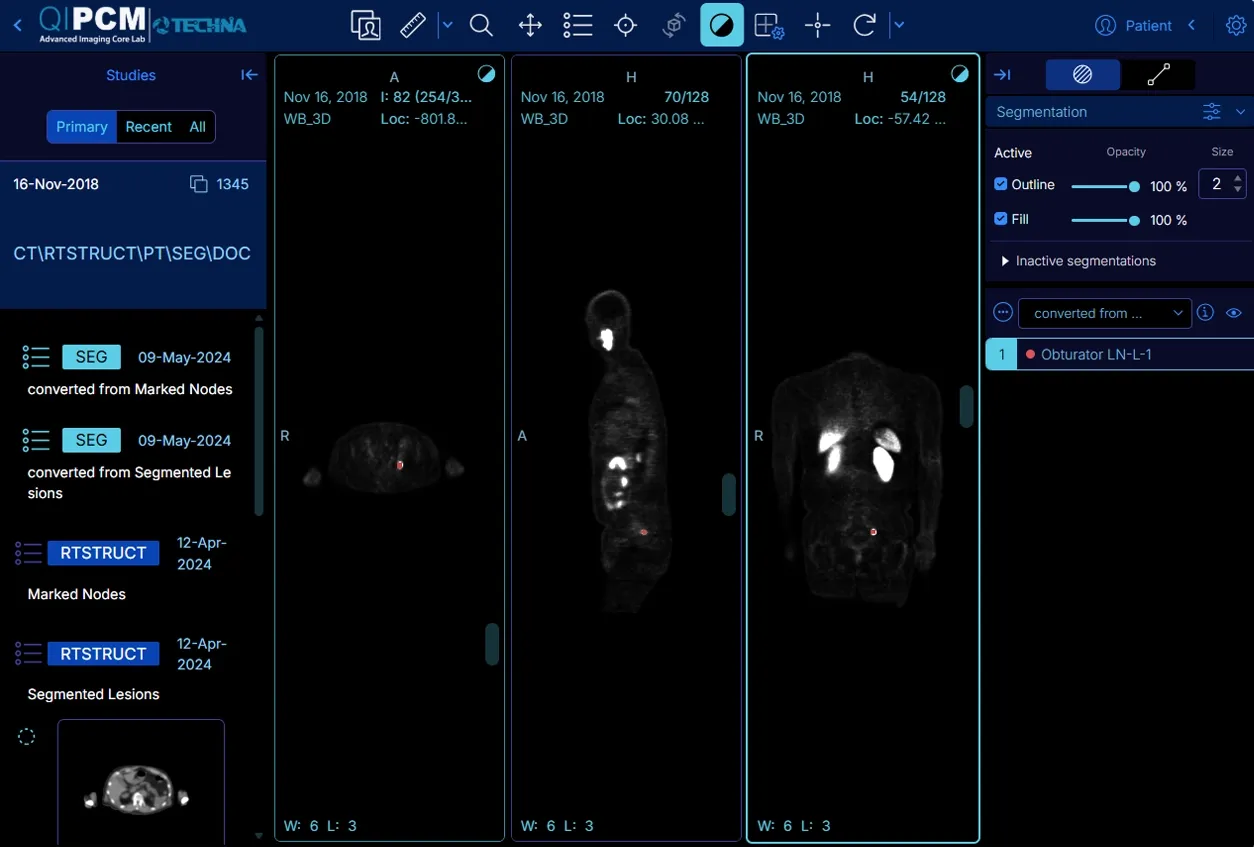 OHIF displaying a whole-body scan in three simultaneous planes with segmentation overlays highlighting marked nodes and lesions
