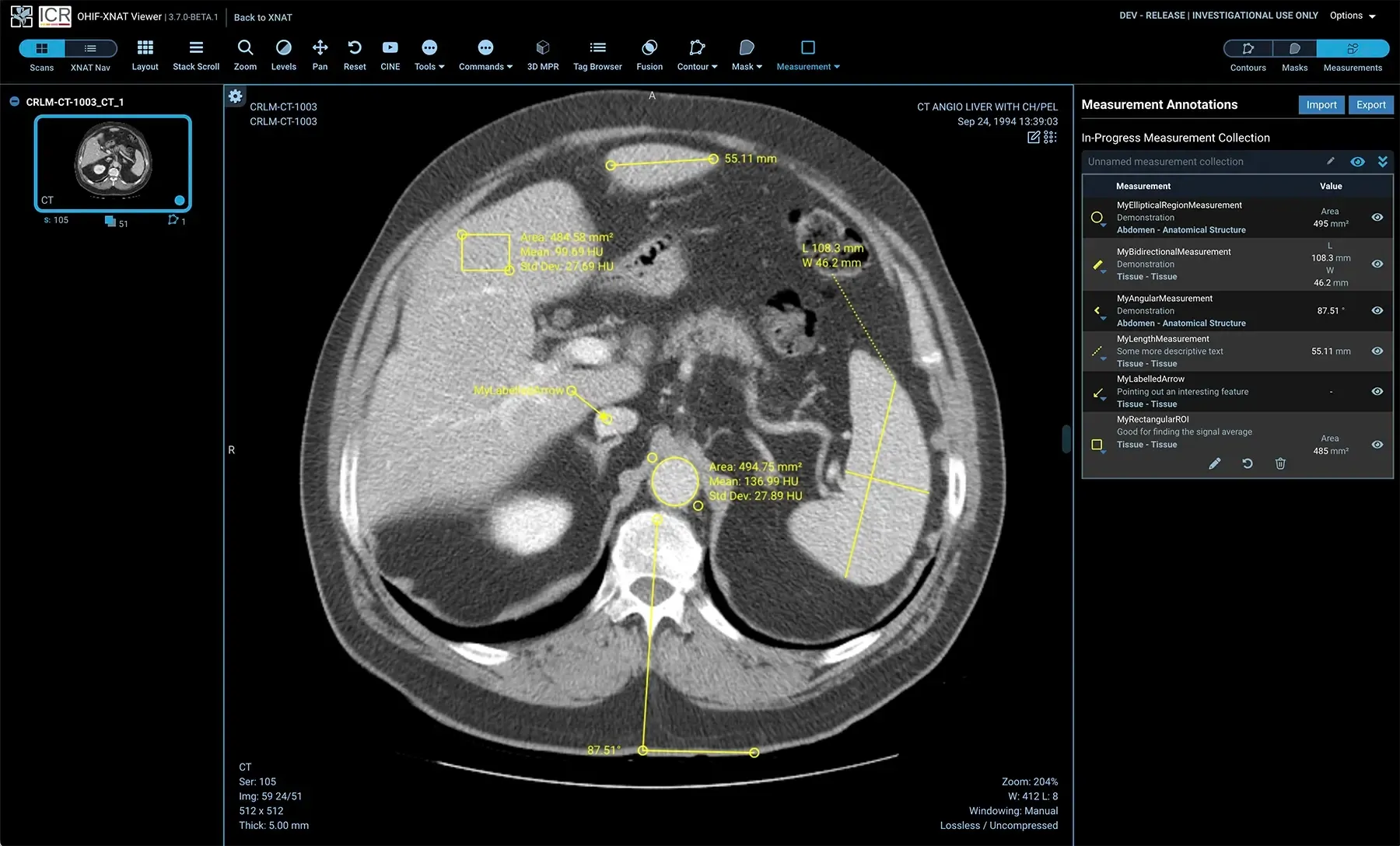 A CT abdominal slice in OHIF with measurement annotations: elliptical region selections showing area and mean Hounsfield units, bidirectional measurements, angular measurements, and length measurements overlaid on the scan